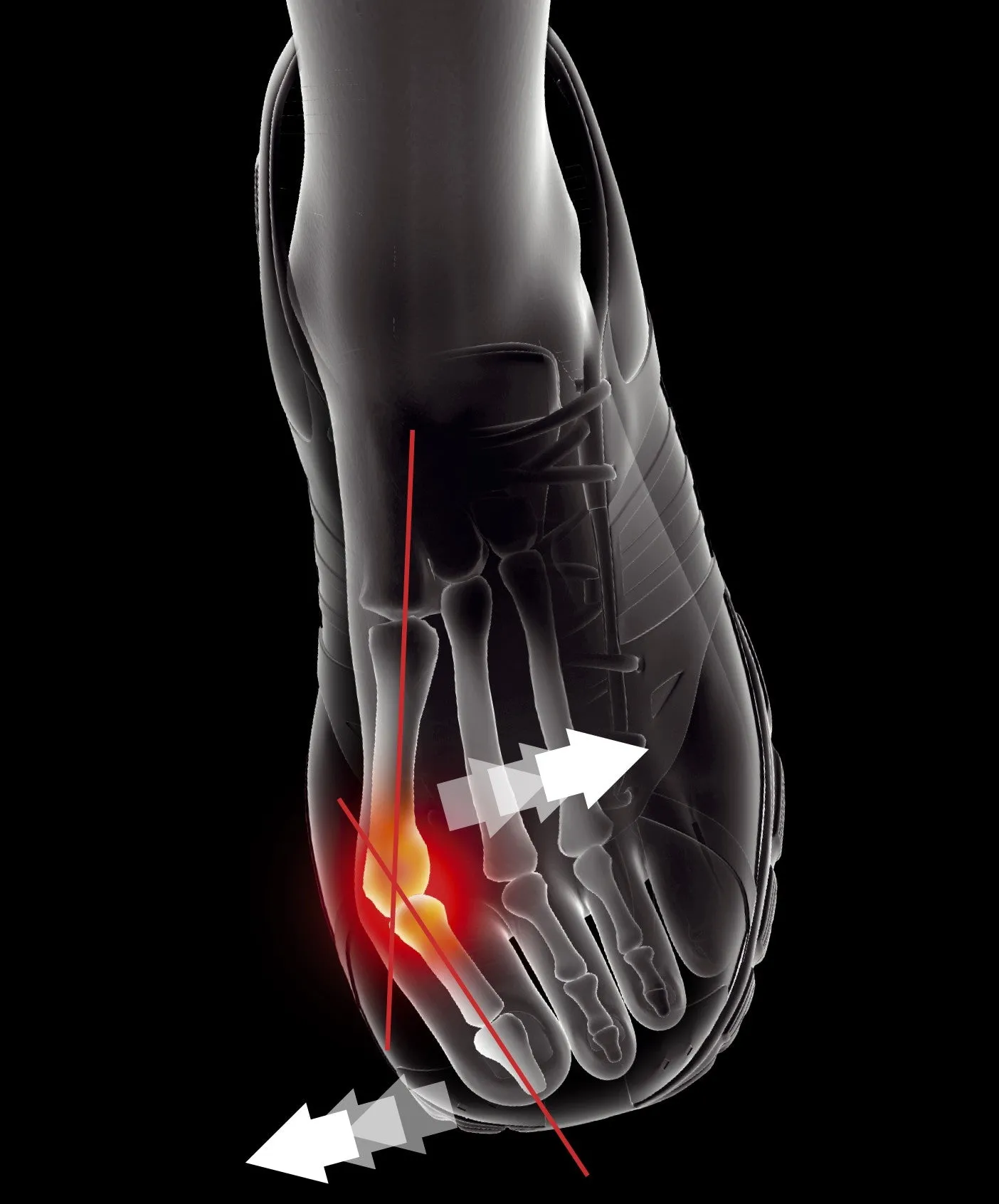 ORTHÈSE CORRECTIVE HALLUX VALGUS SPORT